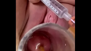 while catheter breaks through internal os and dilates it painfully with balloon